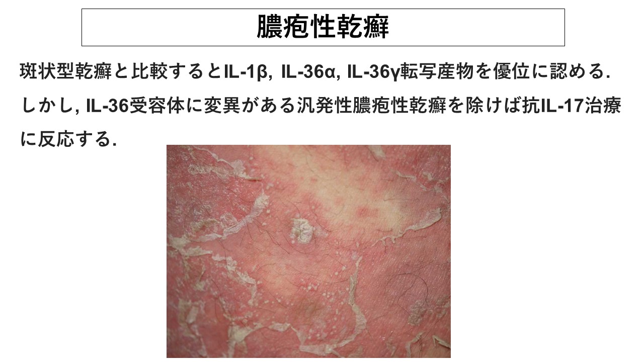 膿疱 性 乾癬
