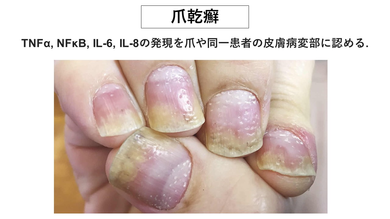 赤い鱗状の皮膚発疹