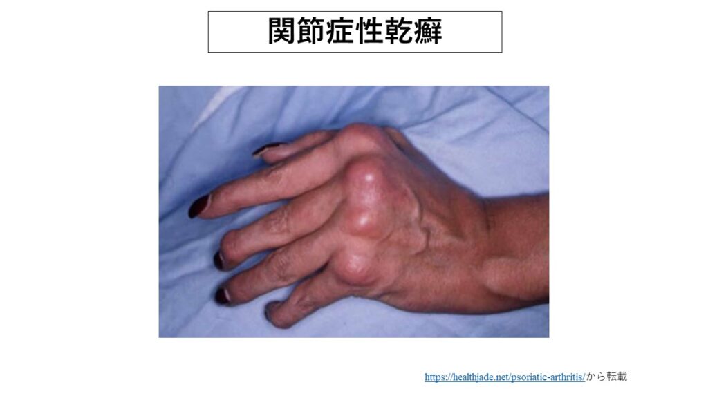  T細胞受容体遮断薬